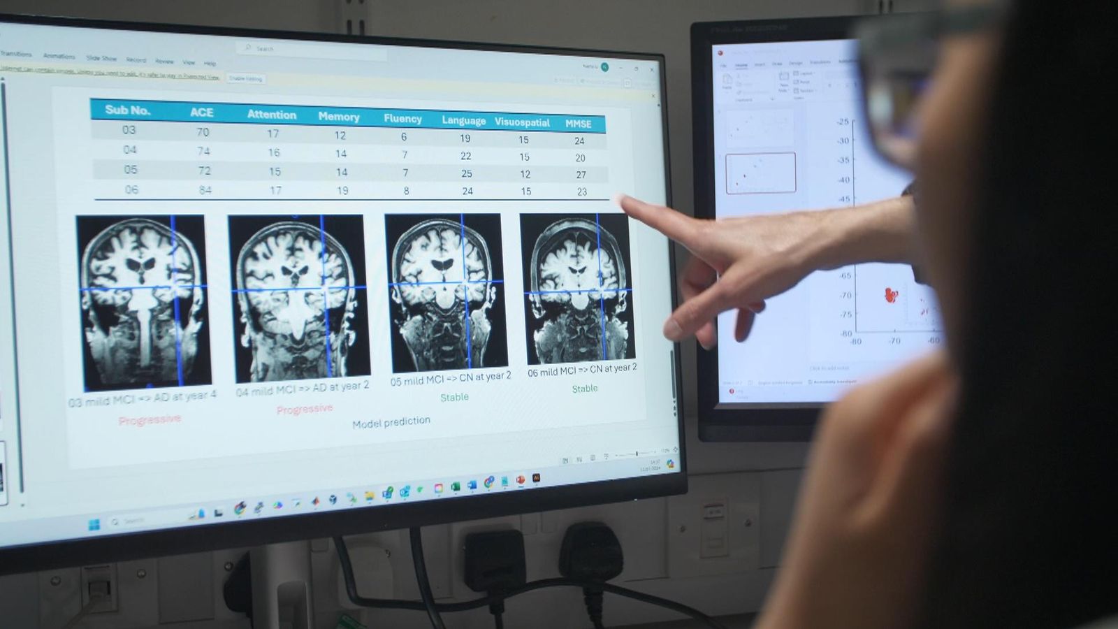 New AI tool could be game-changer in battle against Alzheimer&#39;s