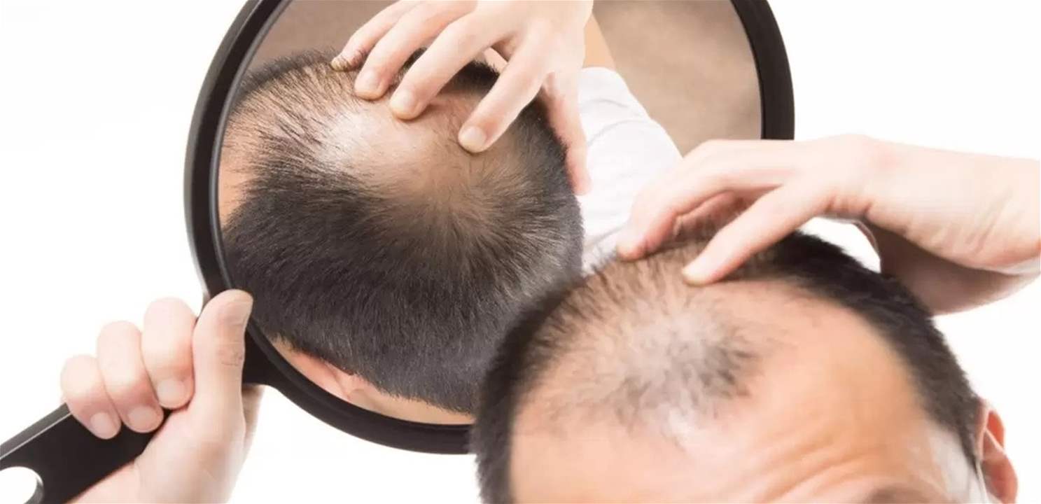 AI helps design baldness treatment that works better than testosterone or minoxidil