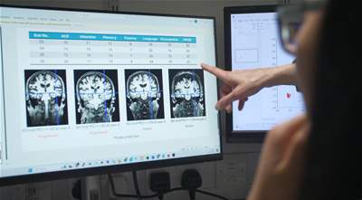 New AI tool could be game-changer in battle against Alzheimer&#39;s